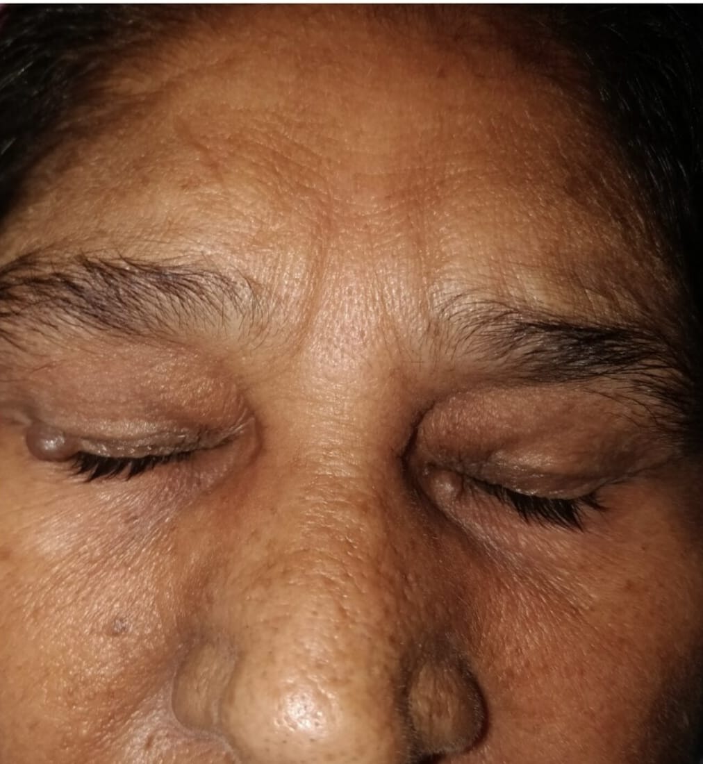 Rhinoplasty Post-Op