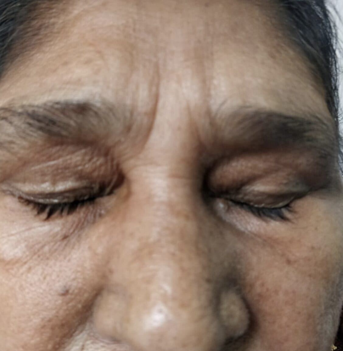 Rhinoplasty Initial State
