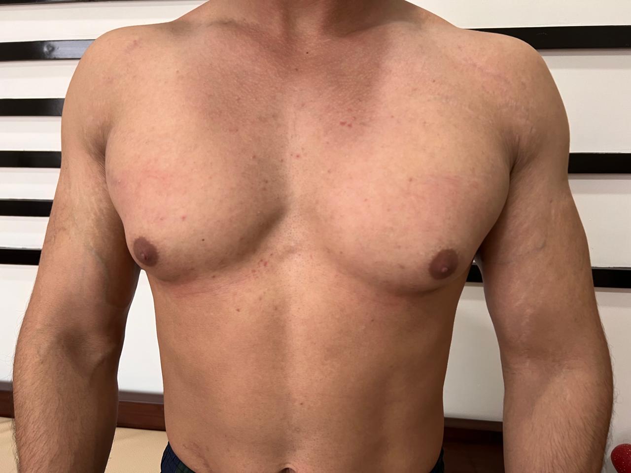 Post-Treatment Restored