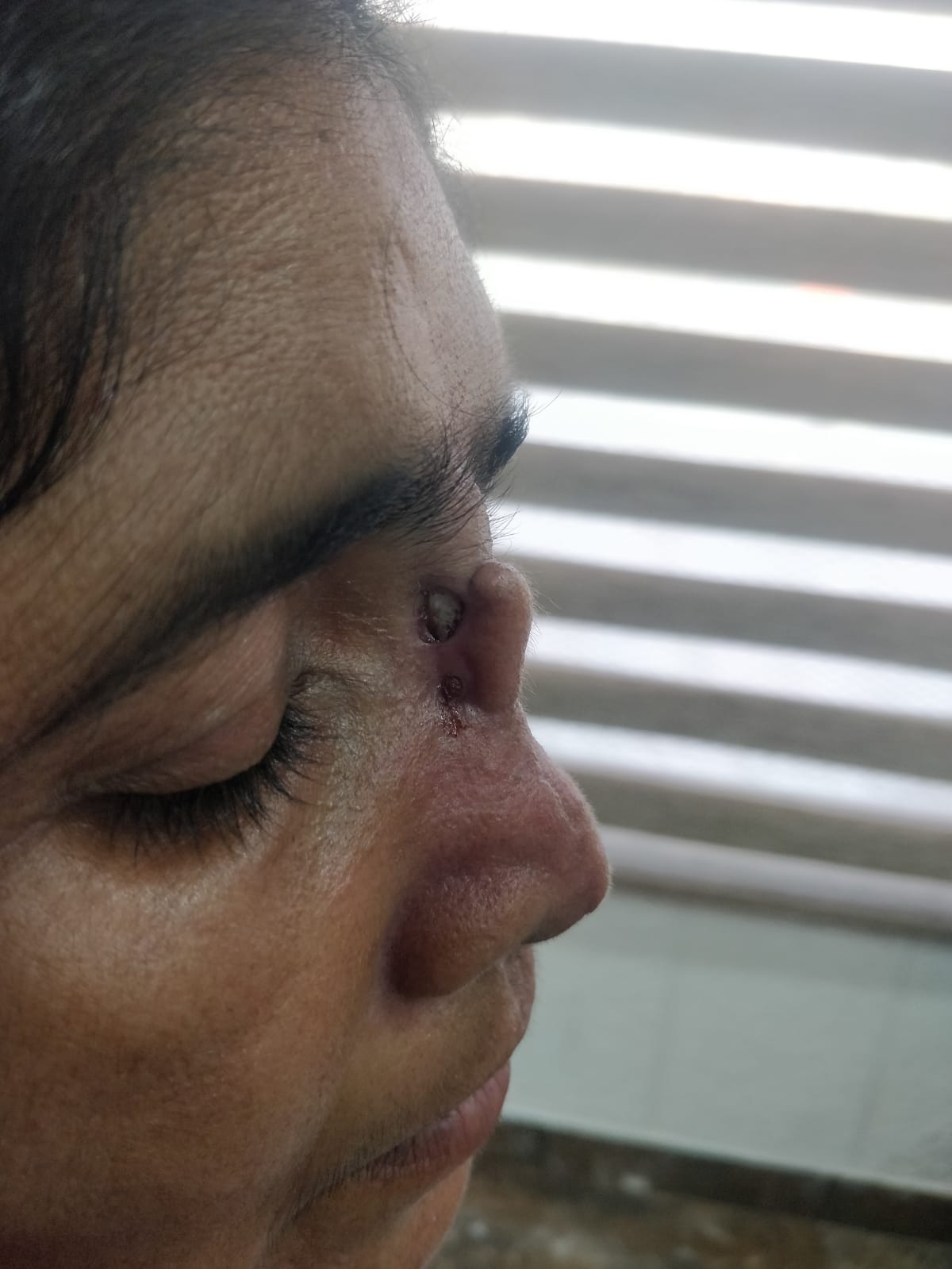 Lip Fillers Post-Op