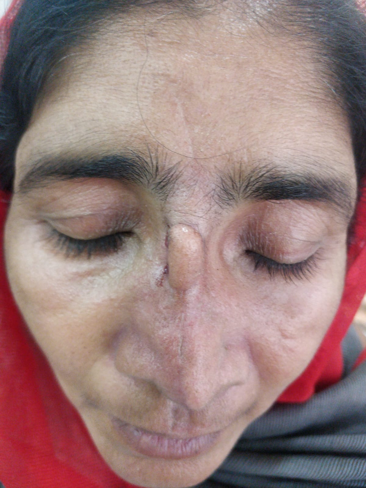 Lip Fillers Before