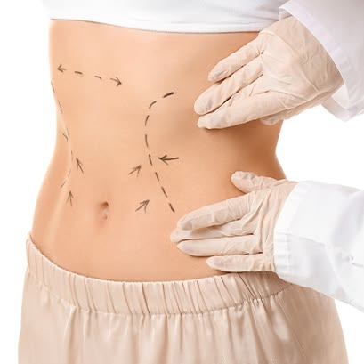 Liposuction